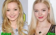 Dove Cameron Before Plastic Surgery